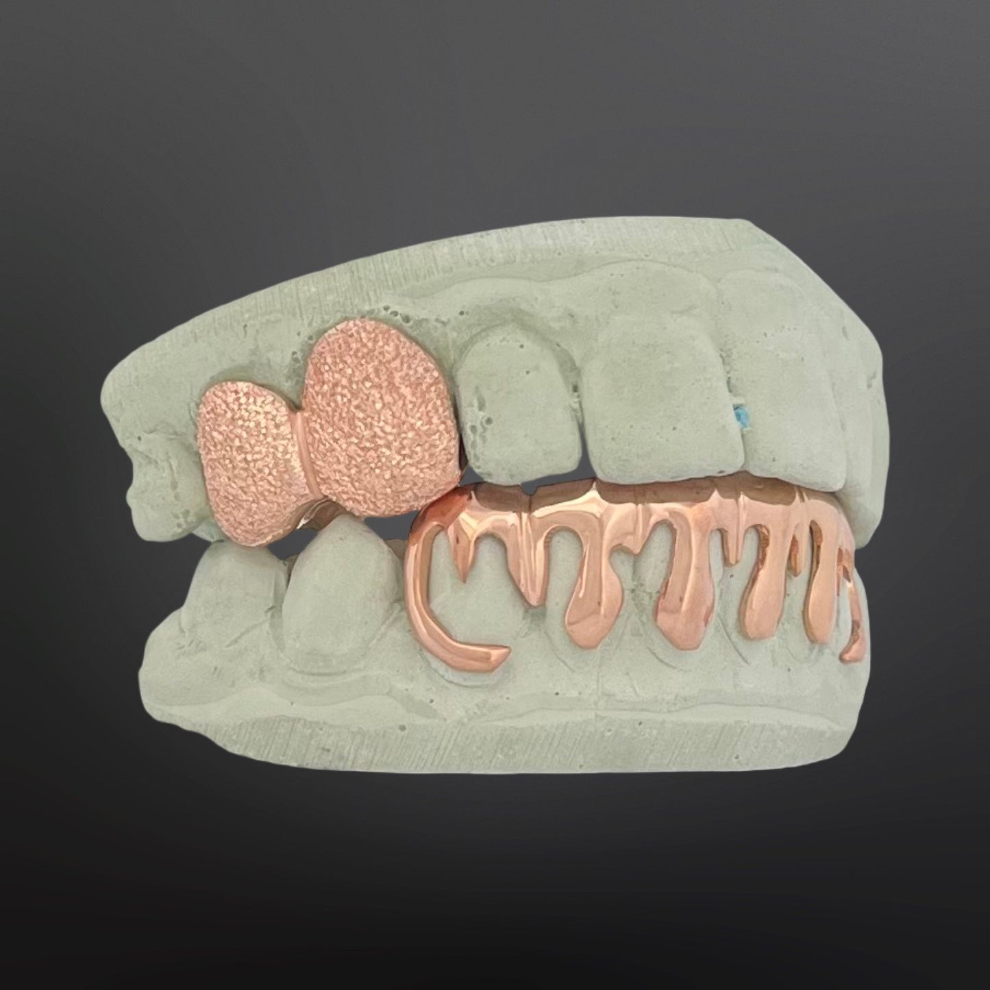 Diamond Dust Two Teeth Top And Drip Design Six Teeth Bottom Full Set Silver Rose